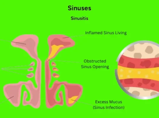 Sinus Congestion Relief: Natural & Effective Methods
