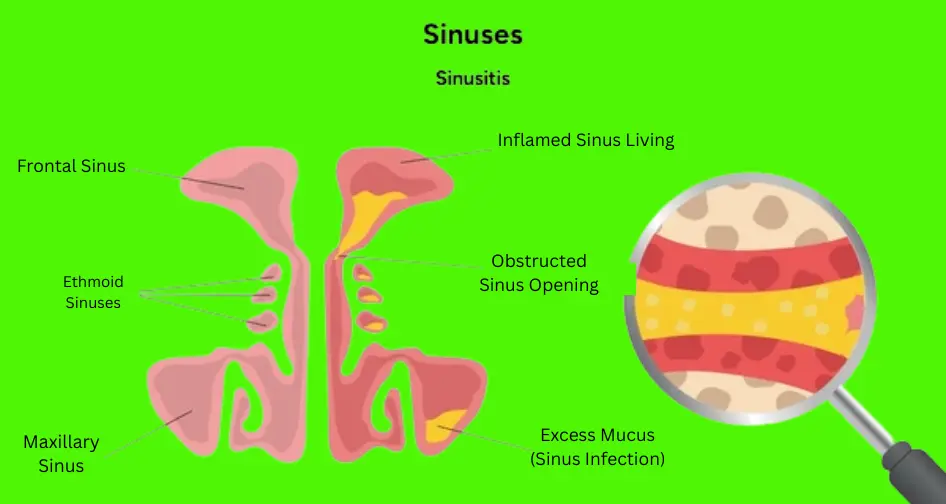 Sinus Congestion Relief: Natural & Effective Methods