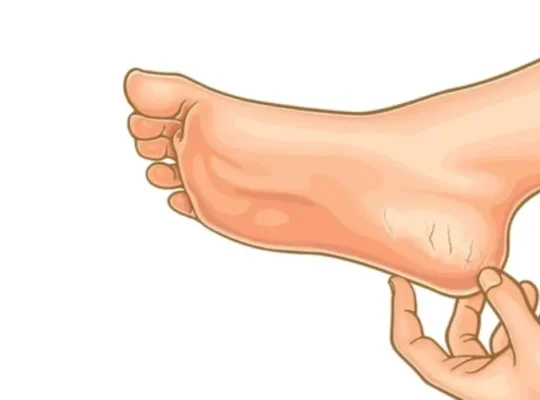 Cracked Heels and Dry Skin: Causes and Treatment Options