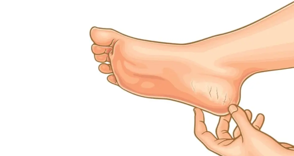 Cracked Heels and Dry Skin: Causes and Treatment Options